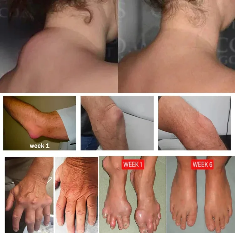 【舒筋透骨快速止痛】苗疆透骨膏讓疼痛遠離你，輕鬆享受每一天的活力！